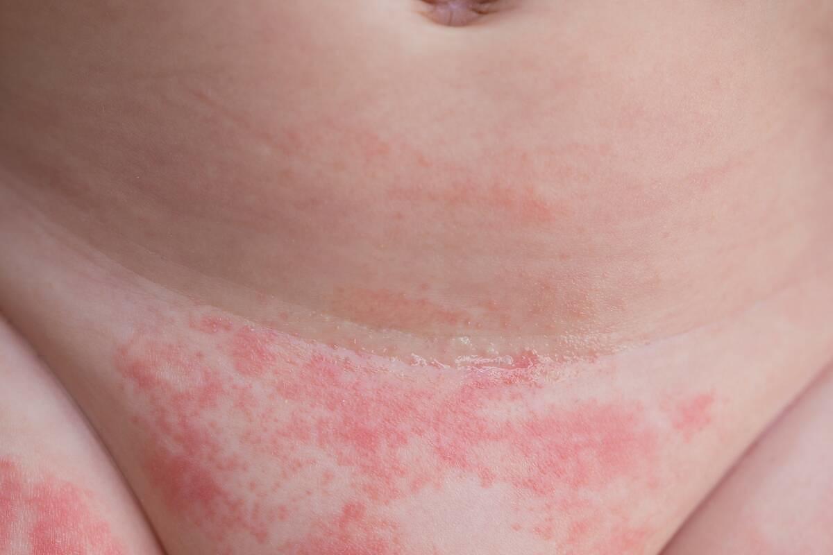 alergia na pampersy