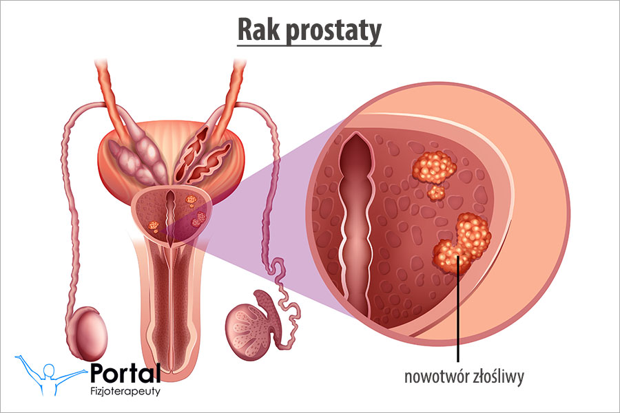 nowotwór prostaty czy należą się pieluchomajtki